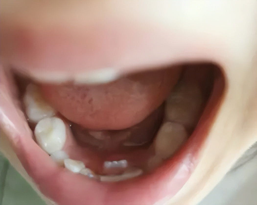 拔出乳牙牙根残留图片,小孩子拔出的乳牙牙根像断了一样
