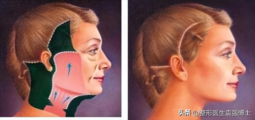 脸部下垂法令纹最有效的办法,改善脸部下垂法令纹最好的方法