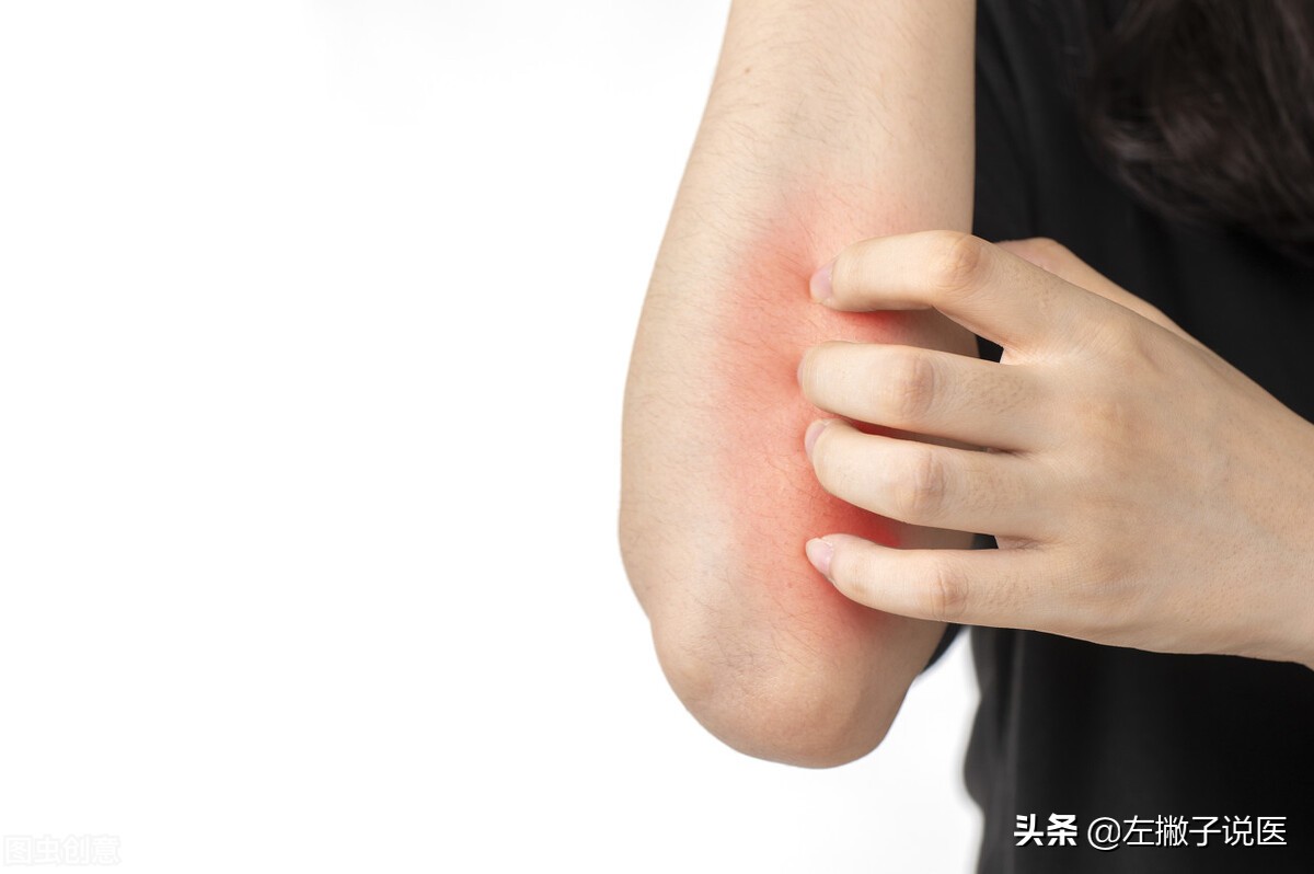 2块钱一支的红霉素软膏3个功效,红霉素软膏真的是皮肤的万能药吗