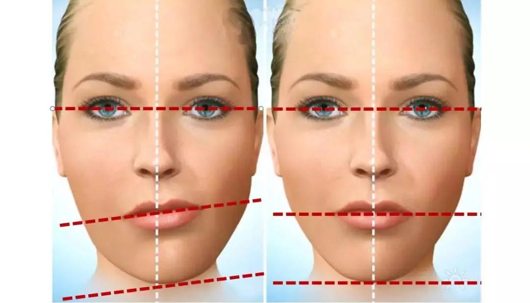 下颌骨歪斜左右不对称如何改善,颧骨高低脸型不对称怎么改善