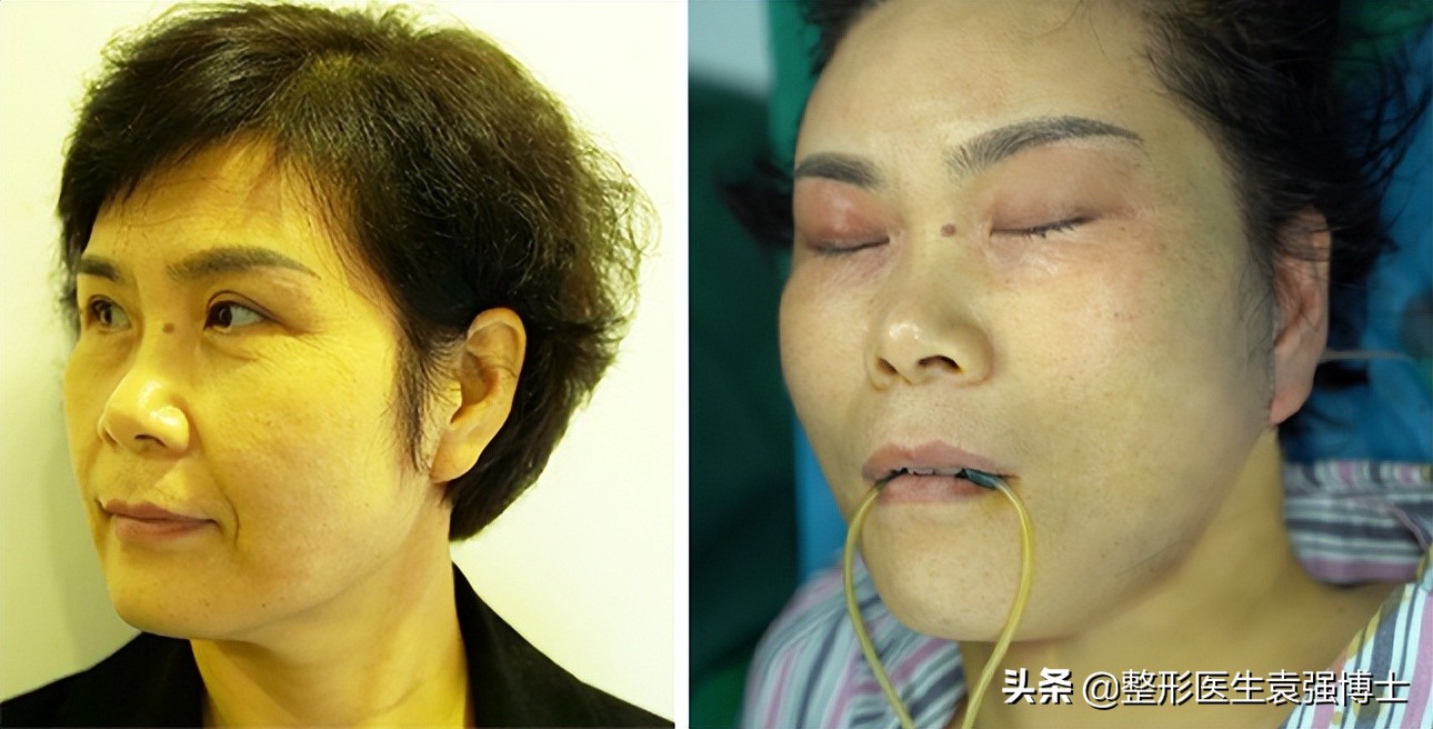 有什么办法能解决法令纹,有法令纹最好的解决办法真实有效