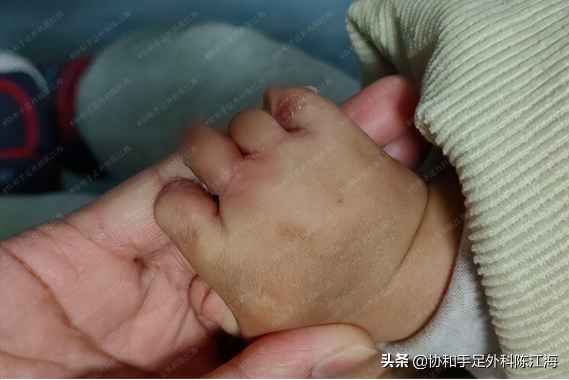 束带综合征手术多大可以做,束带综合征动手术后期有影响吗