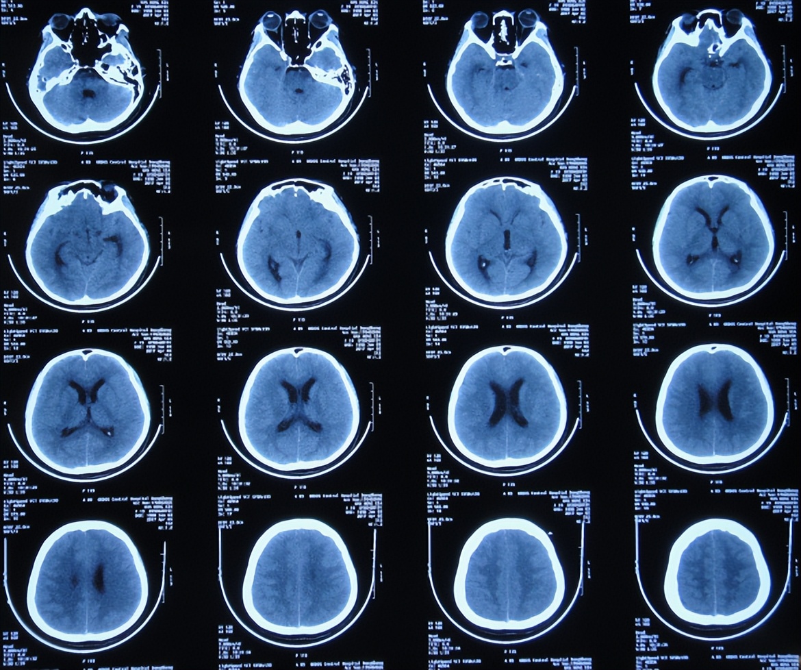 结核性脑积水能治愈吗,儿童结核脑膜炎脑积水