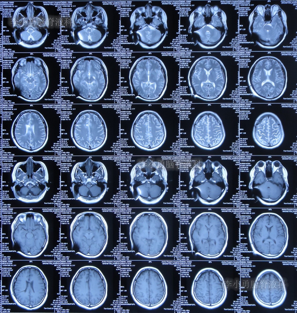 脑积水三脑室造瘘多久能恢复,脑囊虫手术后脑积水