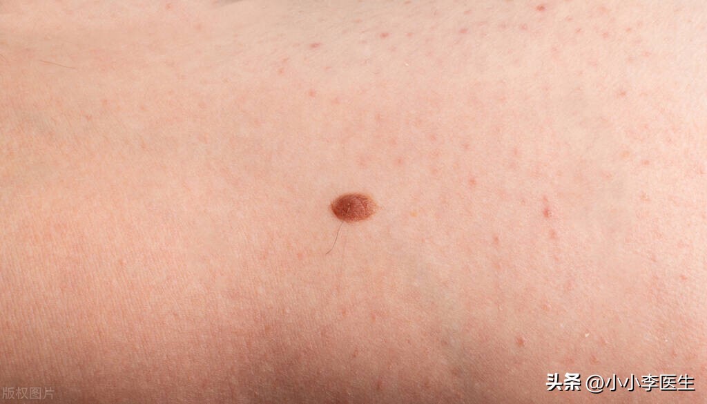 激光祛痣笔真的有用吗,冷冻祛痣好还是激光好