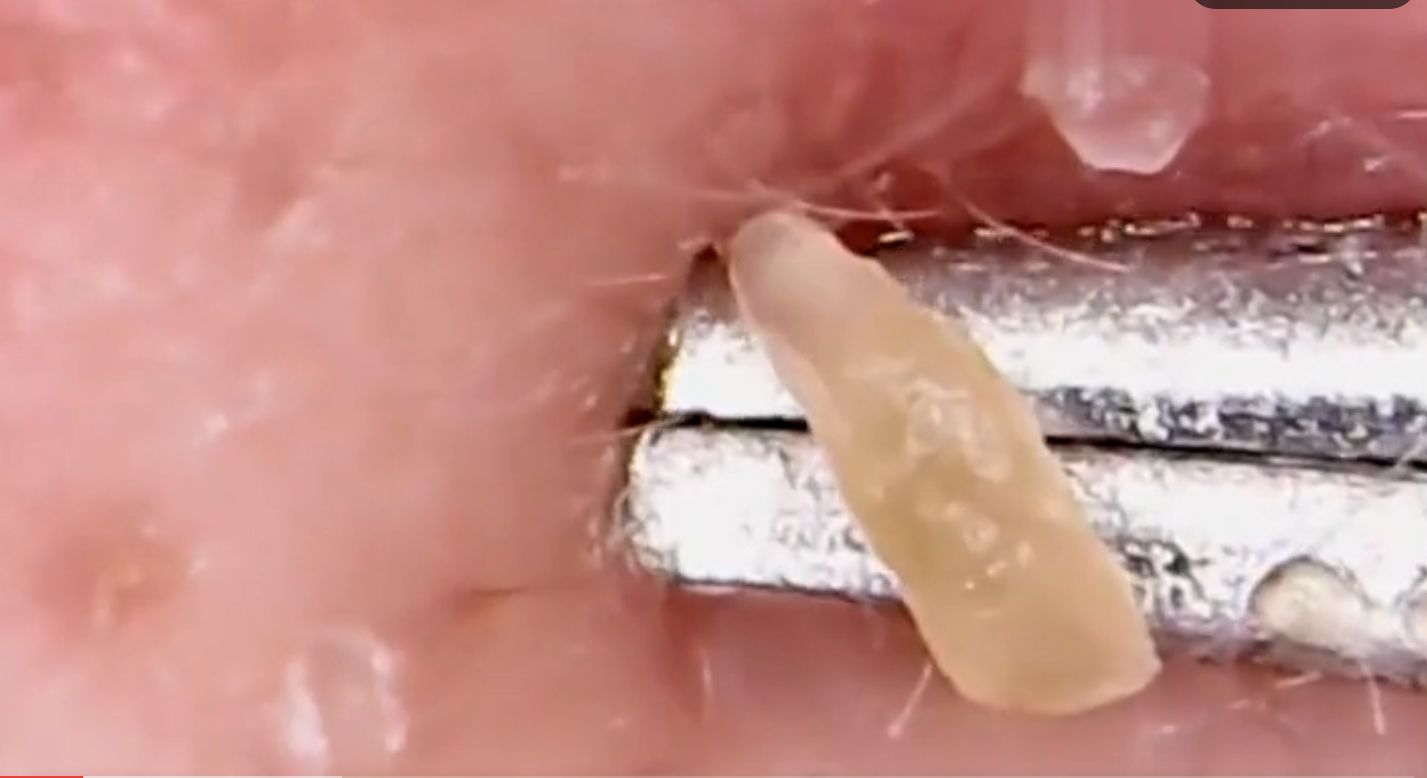 鼻头长黑粉刺怎么回事图片,鼻梁及两侧起了闭口粉刺