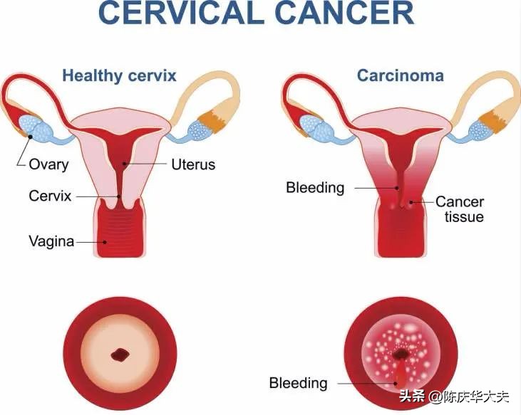 非典型鳞状上皮细胞ascus是啥意思,口腔鳞状上皮非典型增生是癌症吗