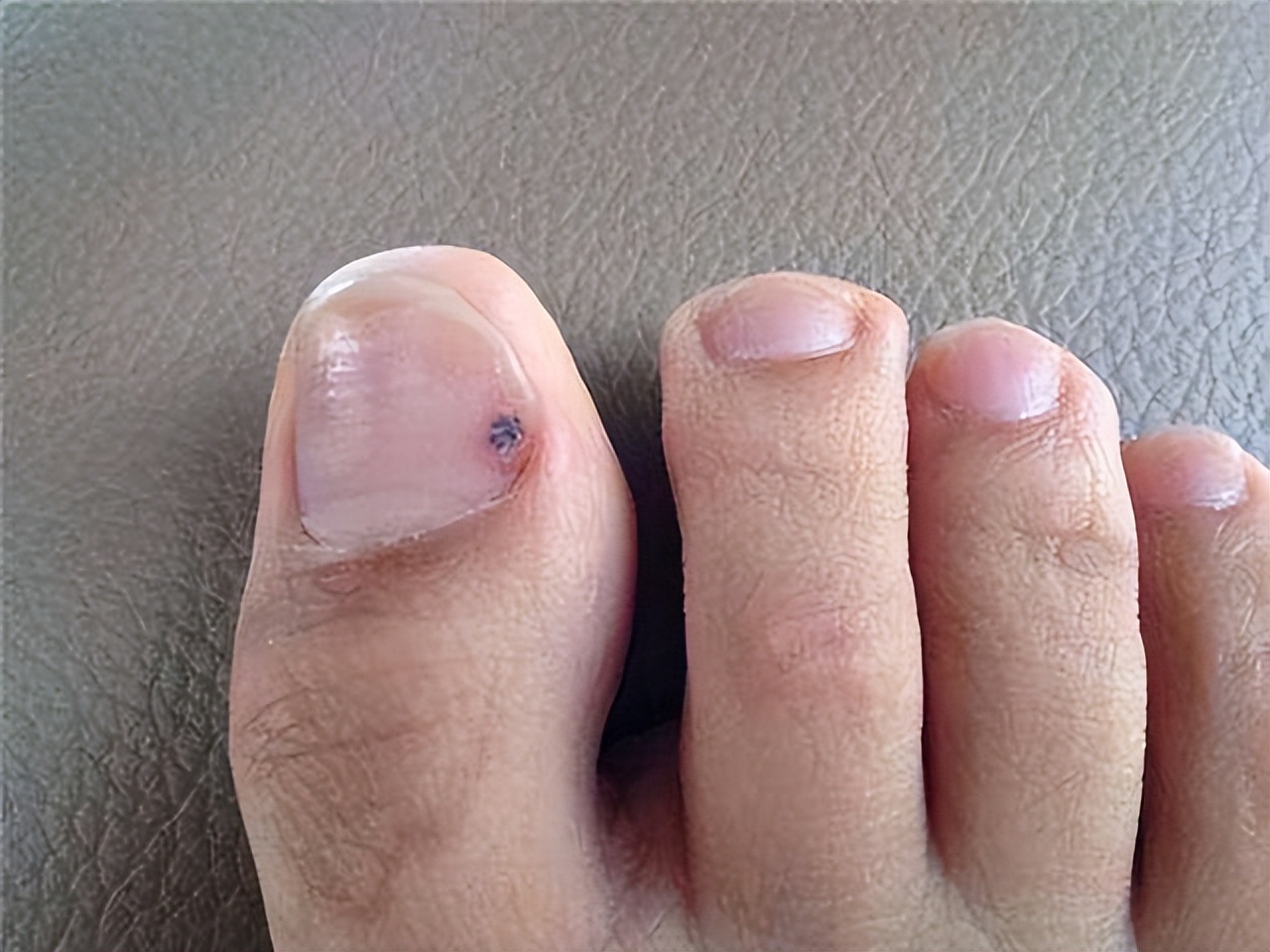 身上痣的好坏的分布图,身上的黑痣有哪些是好的