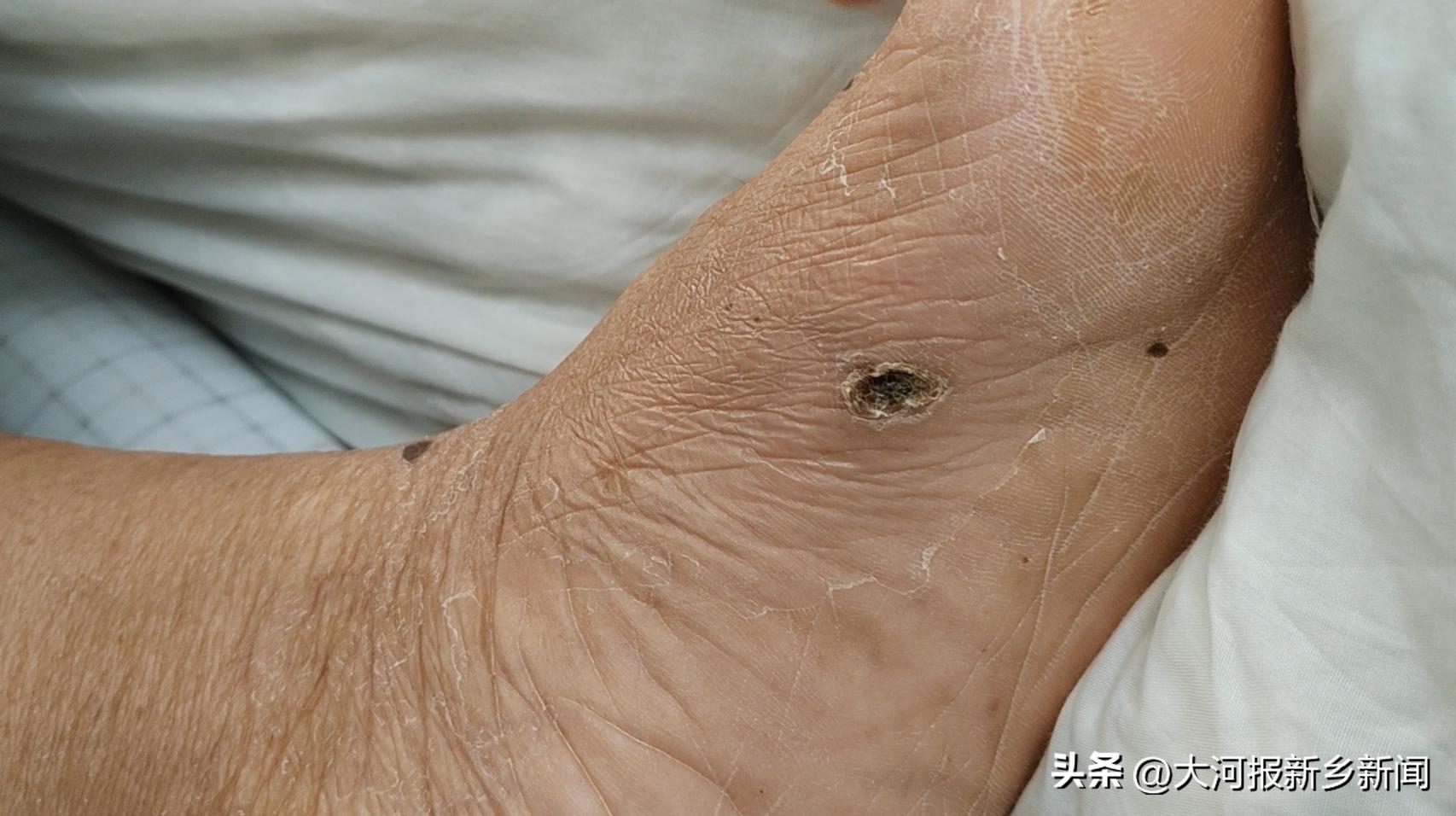 新乡6旬男子浇地扎破脚掌住进ICU医生提醒：伤口处理很关键