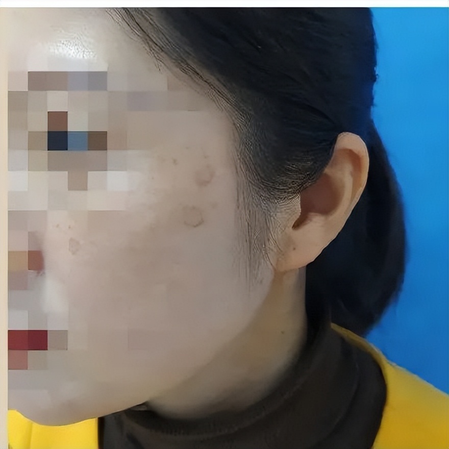 杭州90后姑娘熬夜十年长出老年斑,熬夜造成的老年斑长啥样