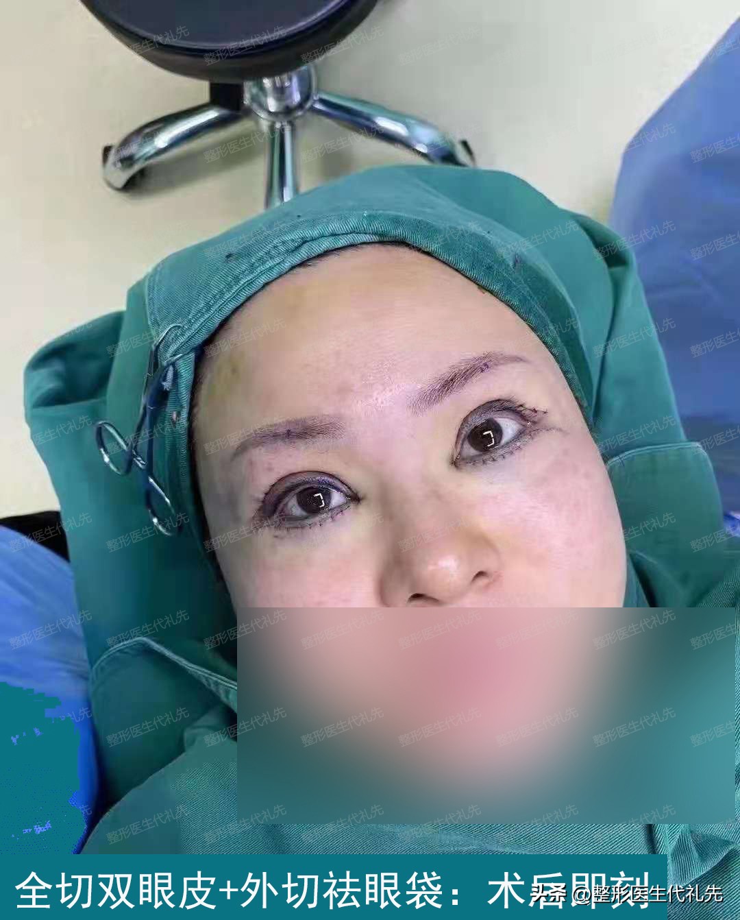 35岁双眼皮切眼袋亲身经历,双眼皮去眼袋全切二个月恢复过程