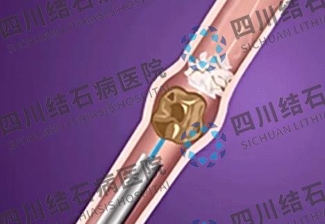 肾结石的自白书：我是肾结石，这是我兴风作浪的一生