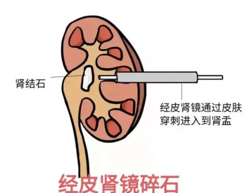儿童有肾结石,儿童多发性肾结石