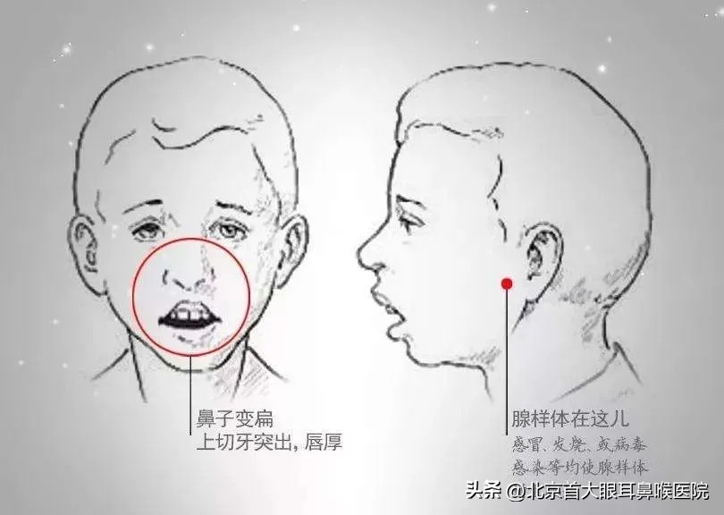 通过整牙能改善腺样体面容吗,腺样体肥大儿童面容吃什么改善