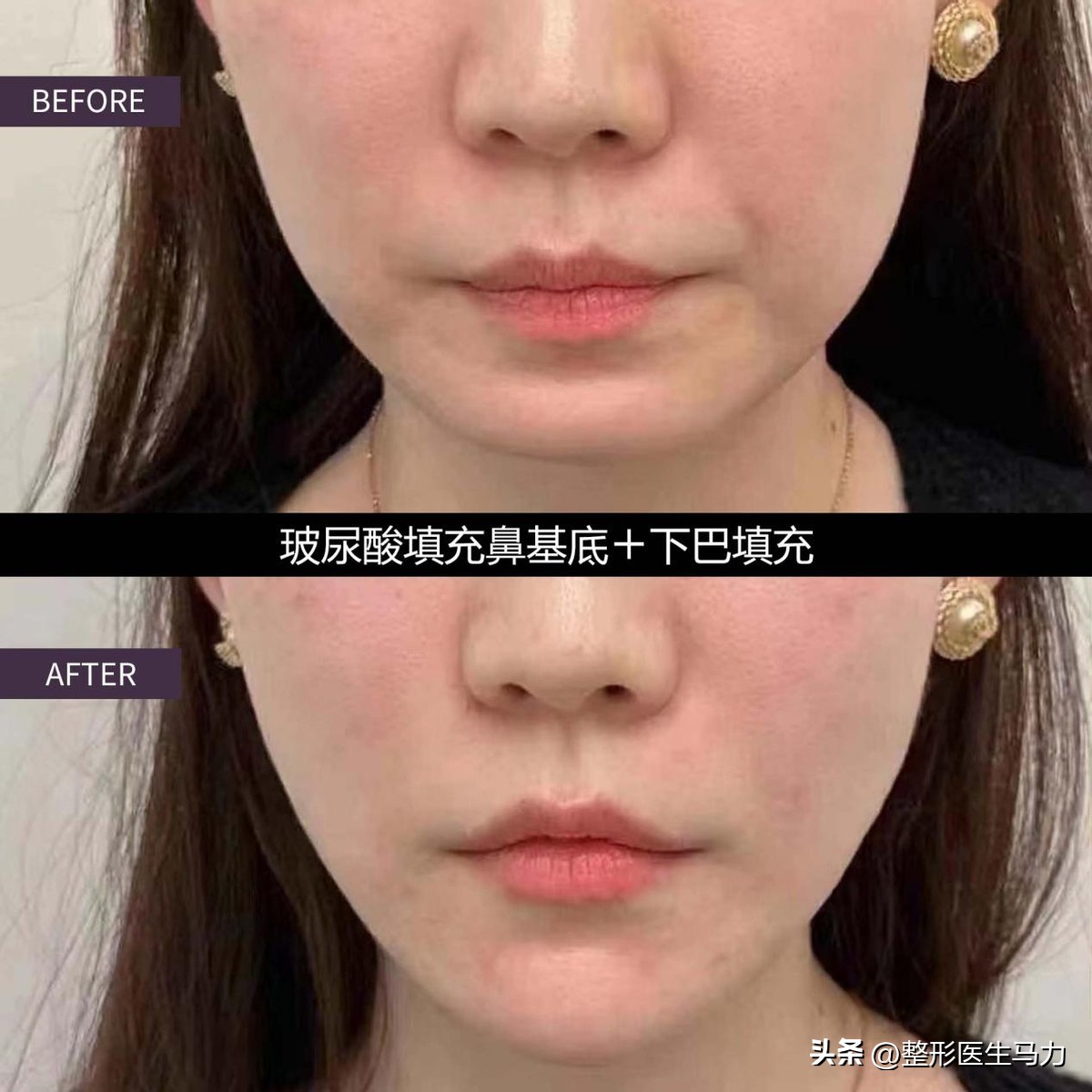 鼻基底玻尿酸栓塞后续治疗方法,鼻基底打玻尿酸栓塞后打溶解酶