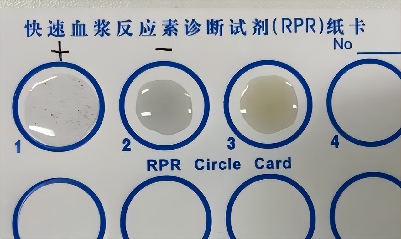 洁身自好，年轻女子却查出梅毒阳性，医生提醒：4个行为要小心