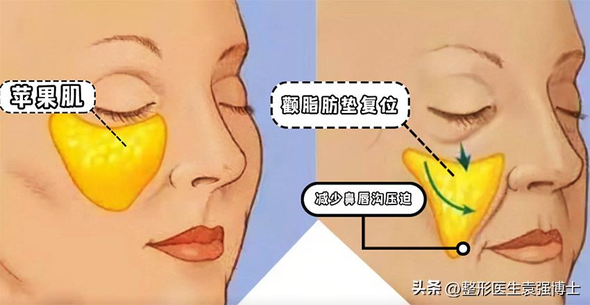 44岁女士拉皮除皱,50岁女人面部拉皮