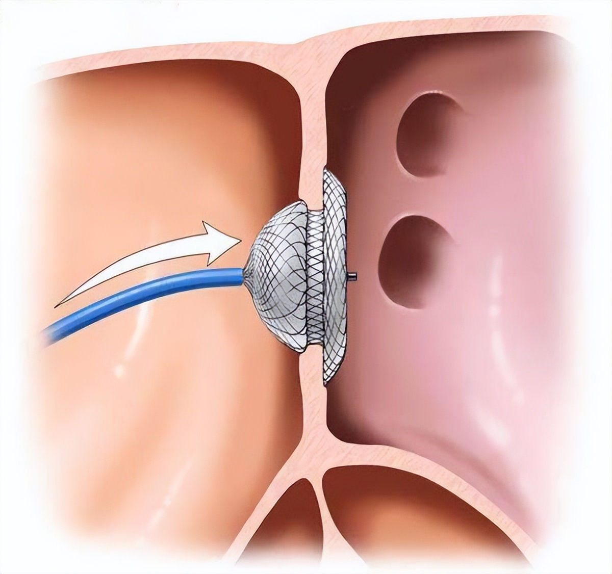 婴儿先天性心脏病怎么护理,婴儿先天性心脏病做什么手术好