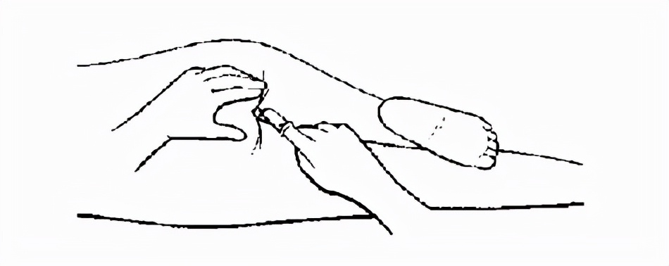 痔疮切除术手术记录,痔疮手术过后家里换药全过程