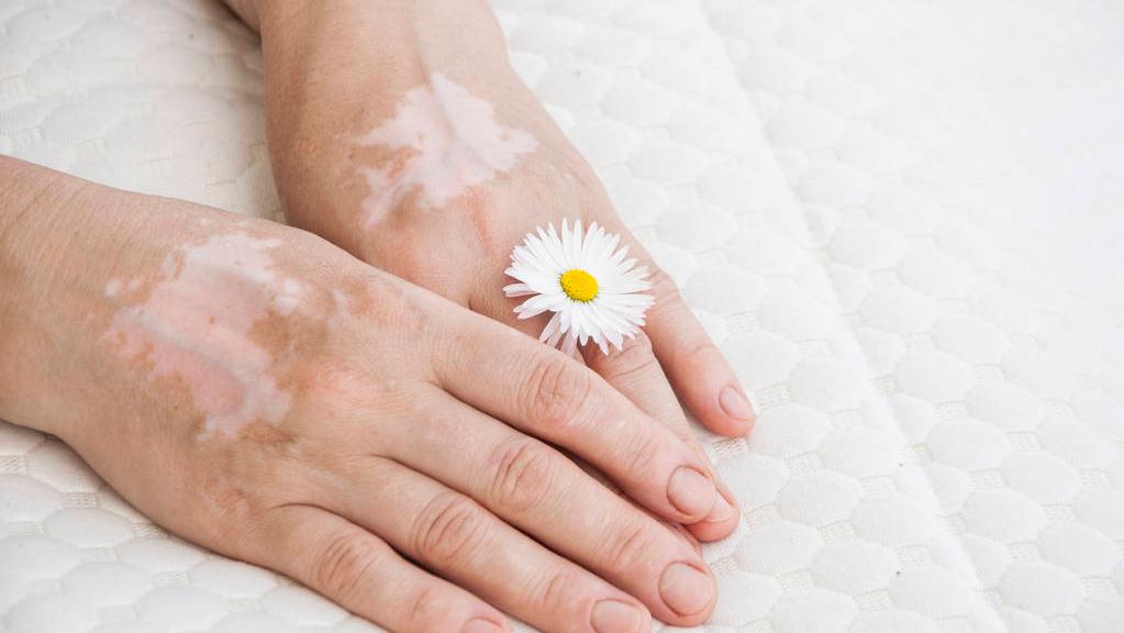 身上有一块白癜风头发也会变白吗,身上长了五处白癜风白斑严重吗