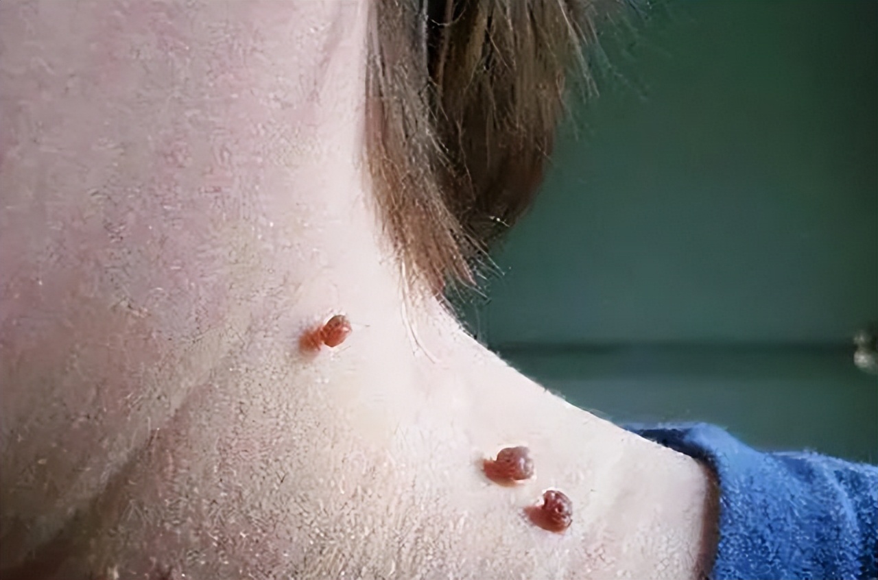 脖子和腋下的“小肉粒”是什么？能用手抠掉吗？看看医生如何说