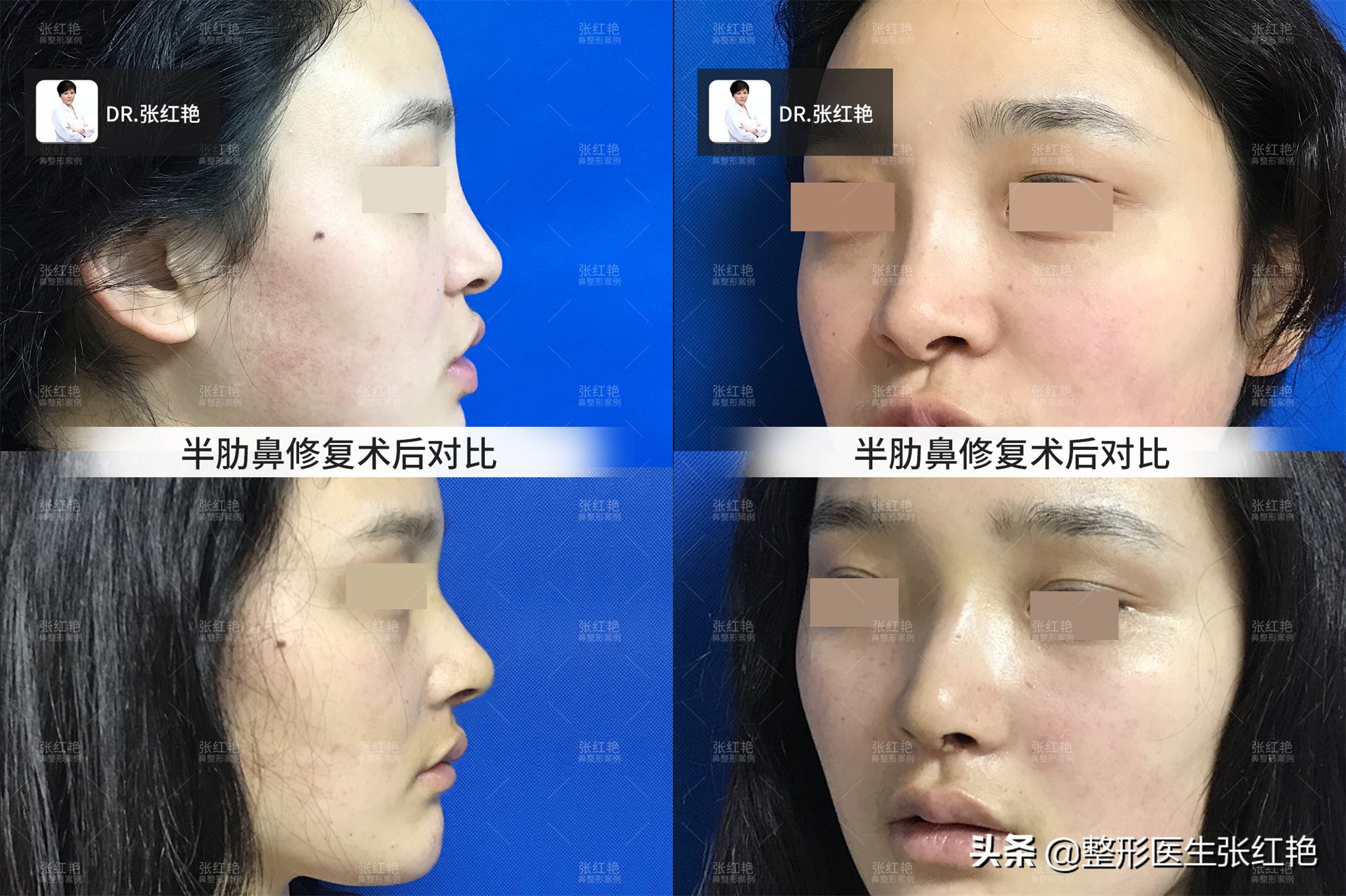 整容鼻子成功案例,鼻子整形有哪些鼻子形状