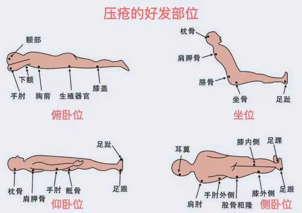 什么是压疮护理措施和方法,为什么会压疮