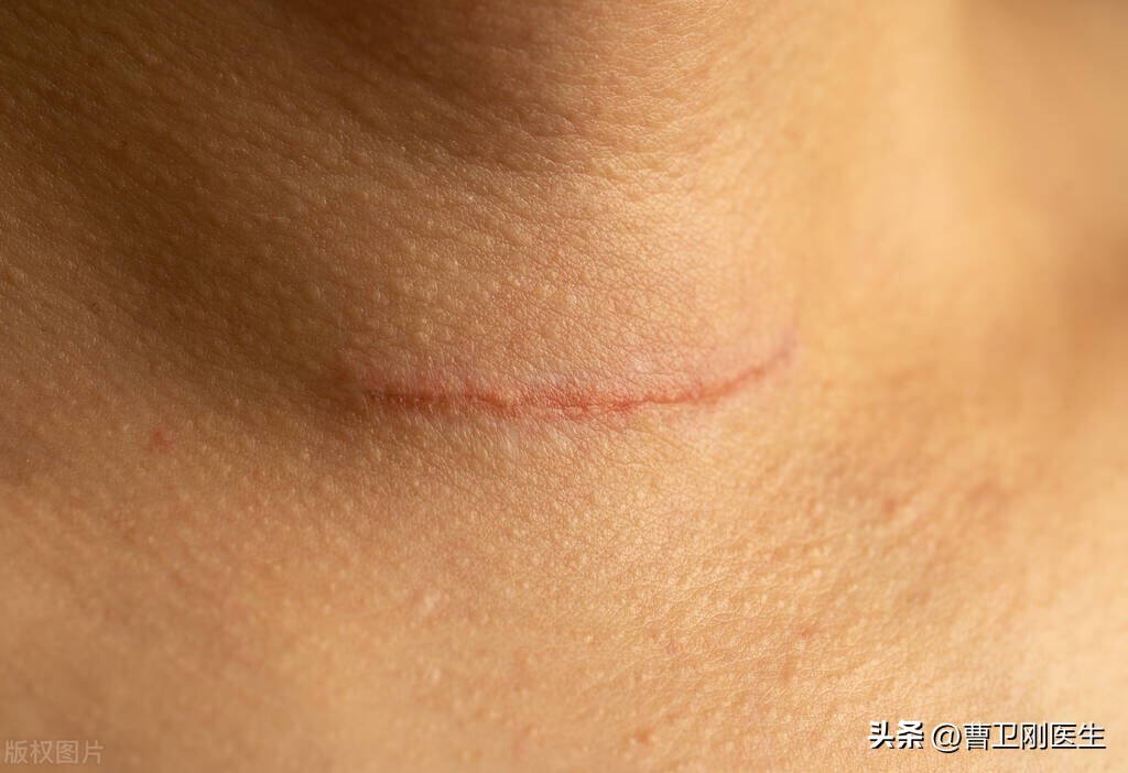 美国ATA：甲状腺结节6种处理方法，如何选择？