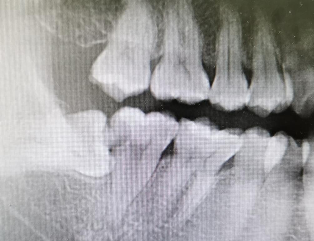牙疼受不了,却找不到问题?有可能是牙髓发炎了