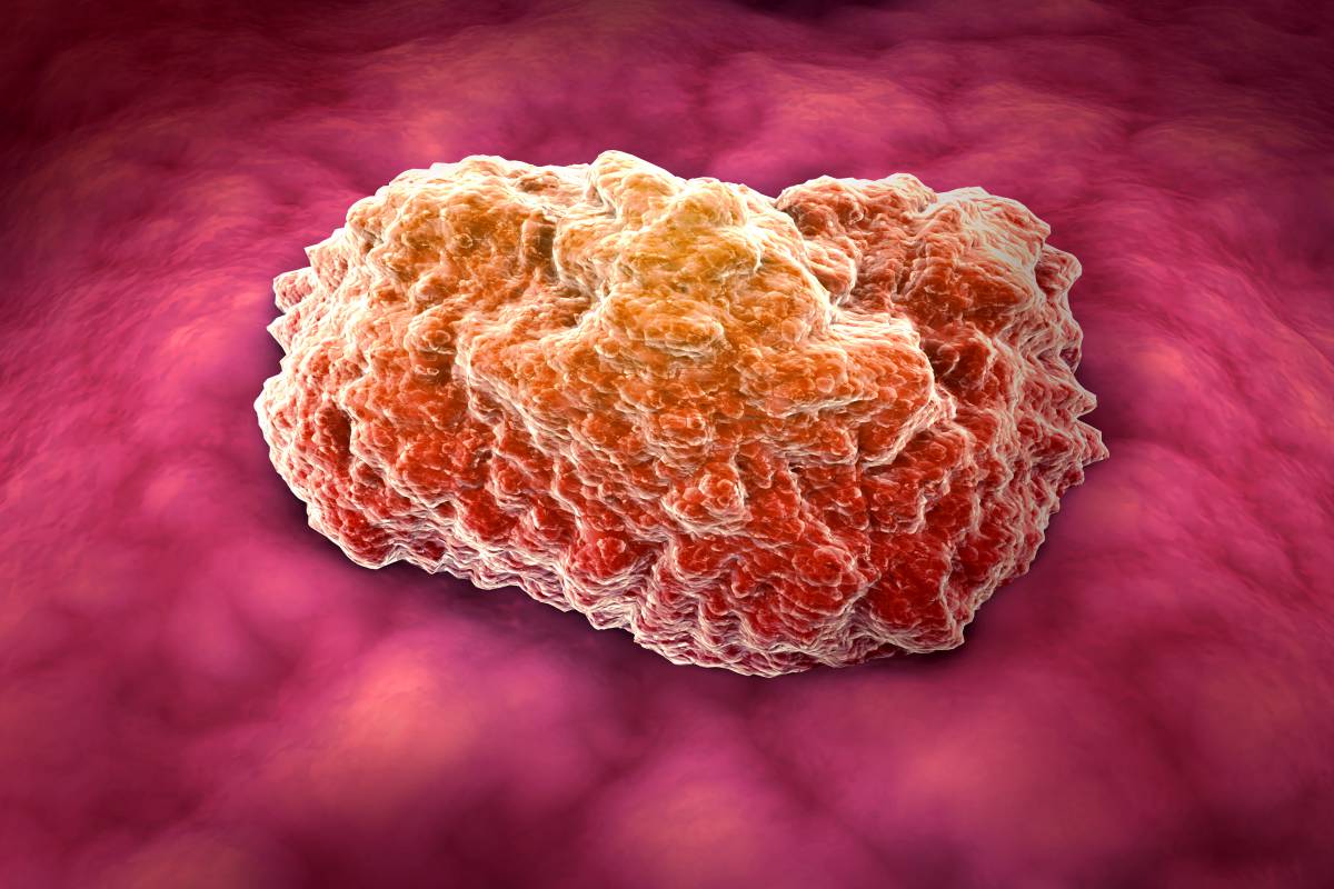 肝癌小细胞癌的治疗方法,肝癌的诊断和治疗方法简答题