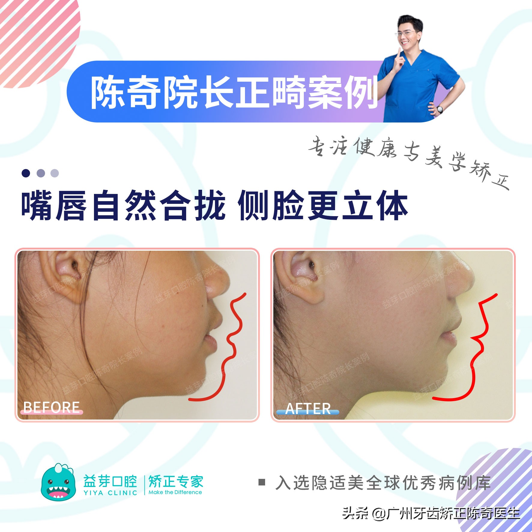 11岁女孩牙齿前突需要扩弓吗,16岁女生上颌骨前突矫正