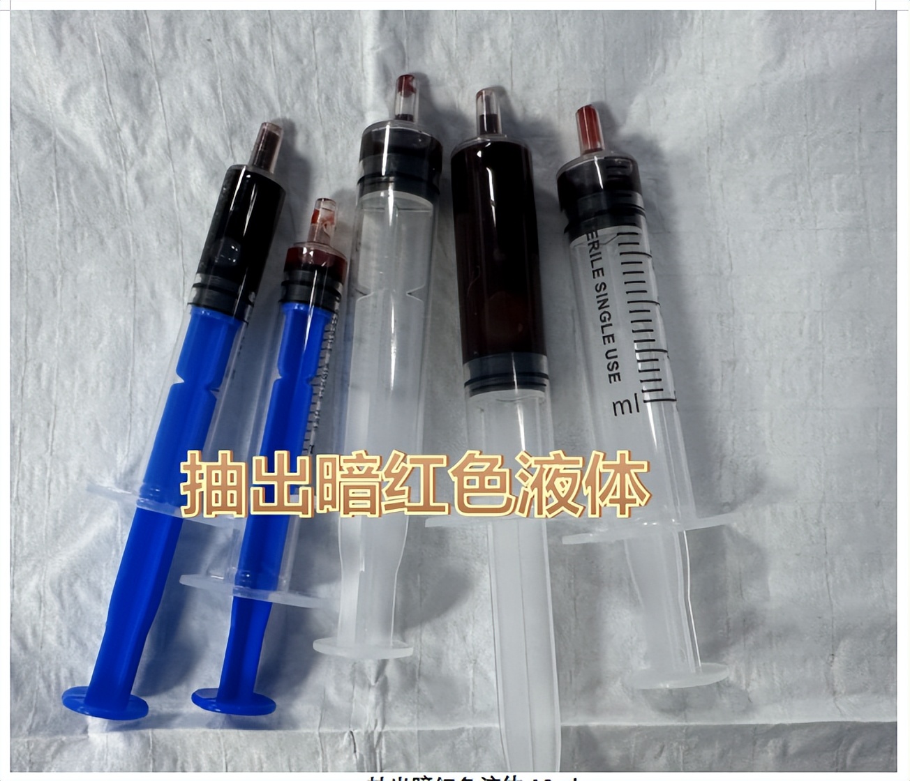 儿童腹部淋巴管瘤微创多久能下床,婴儿颈后淋巴管瘤介入治疗