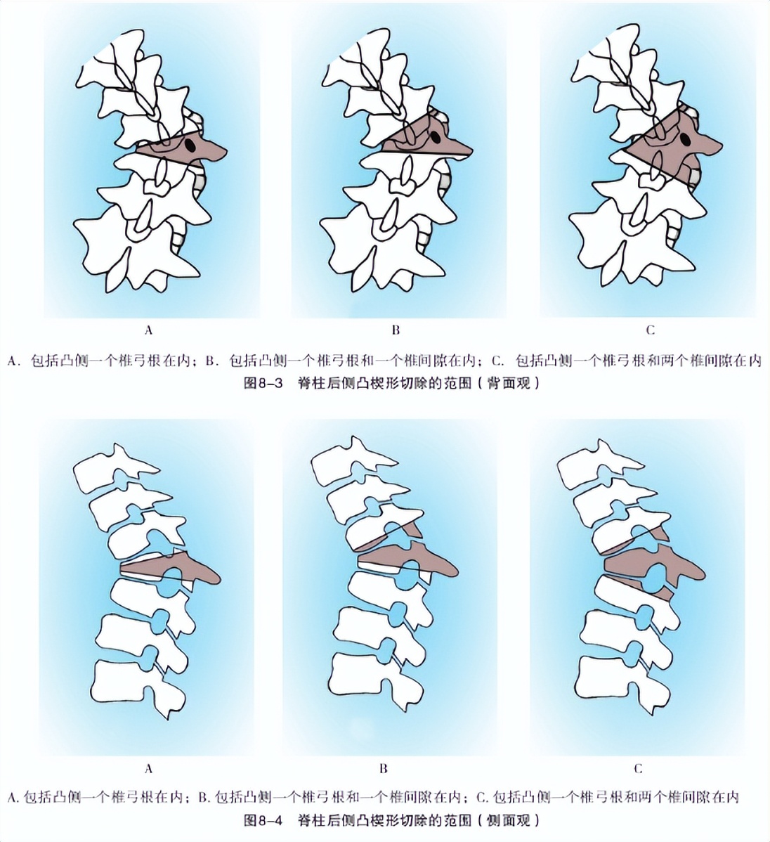 骨科基础：脊柱后侧凸截骨术