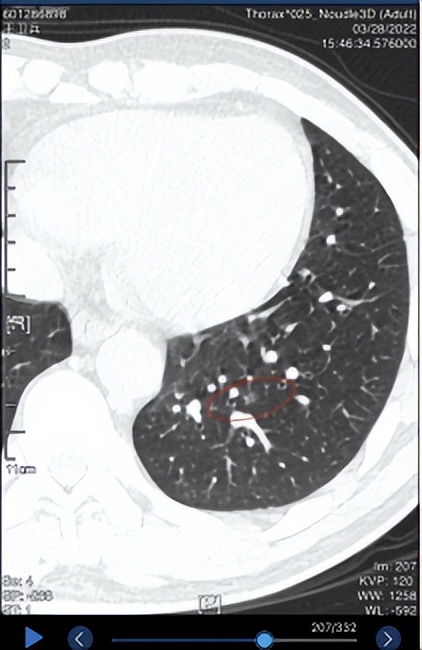 肺部磨玻璃结节0.5*0.4需要手术吗,肺部6mm*9mm的磨玻璃结节问题大吗