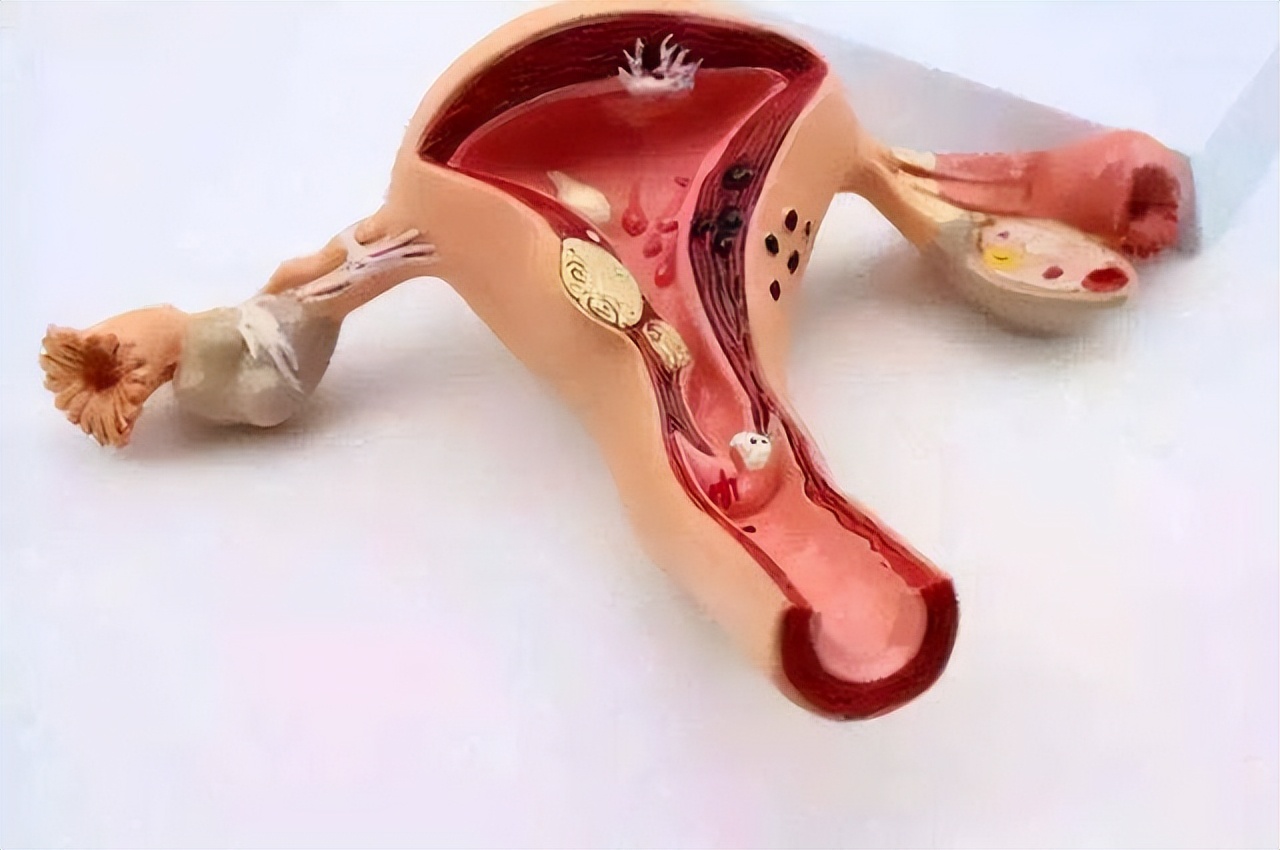 结扎的女性卵子怎么排出来的,女性结扎之后卵子如何排出