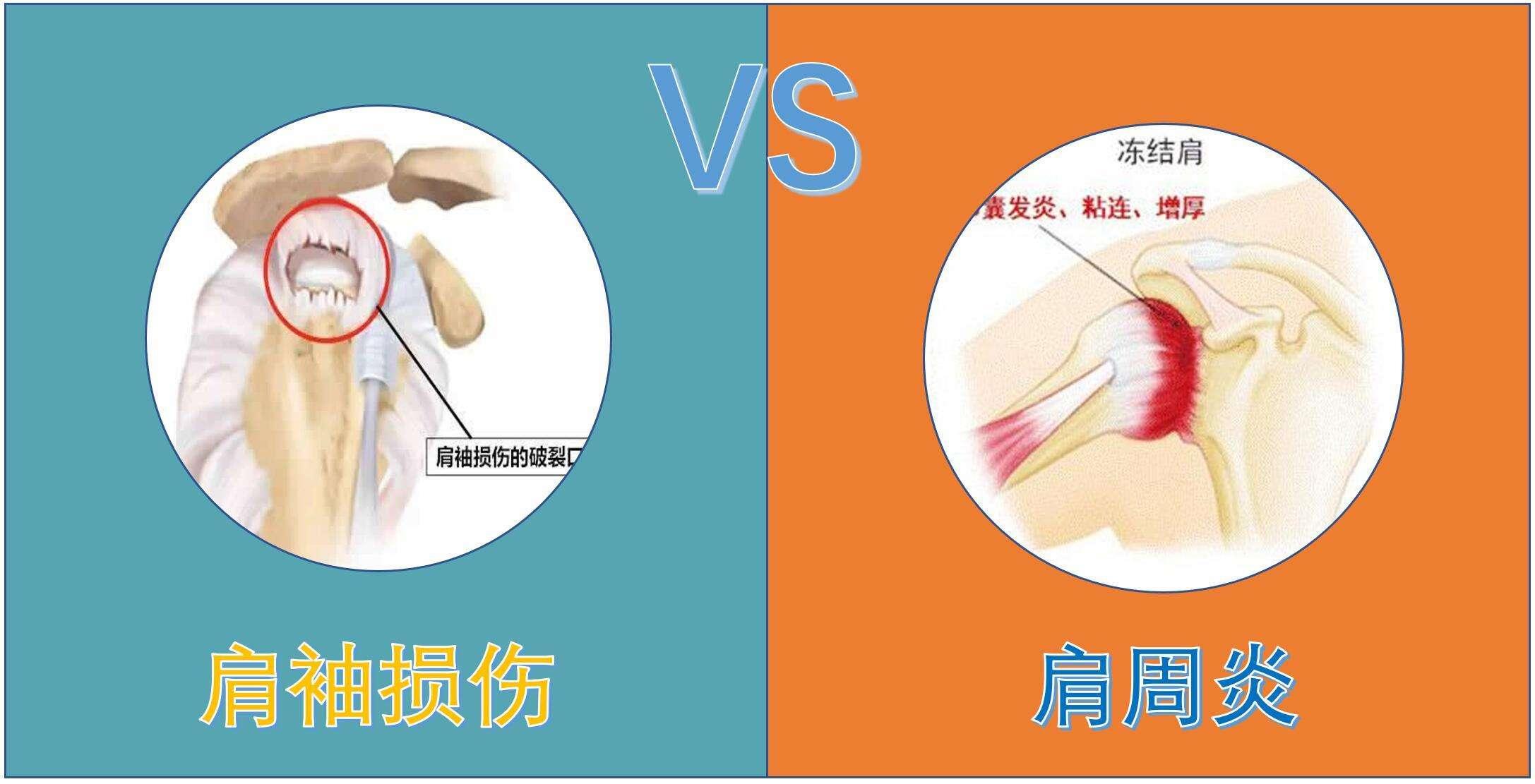 肩膀疼运动一下,运动肩膀疼痛怎么治疗最快最好