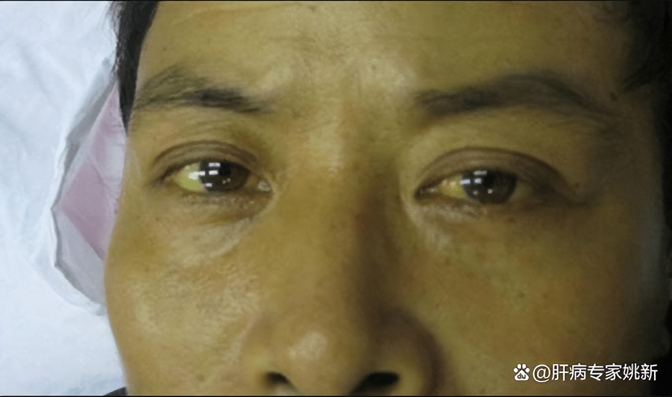 胆红素偏高一定得治吗能自愈吗,胆红素高的调理方法