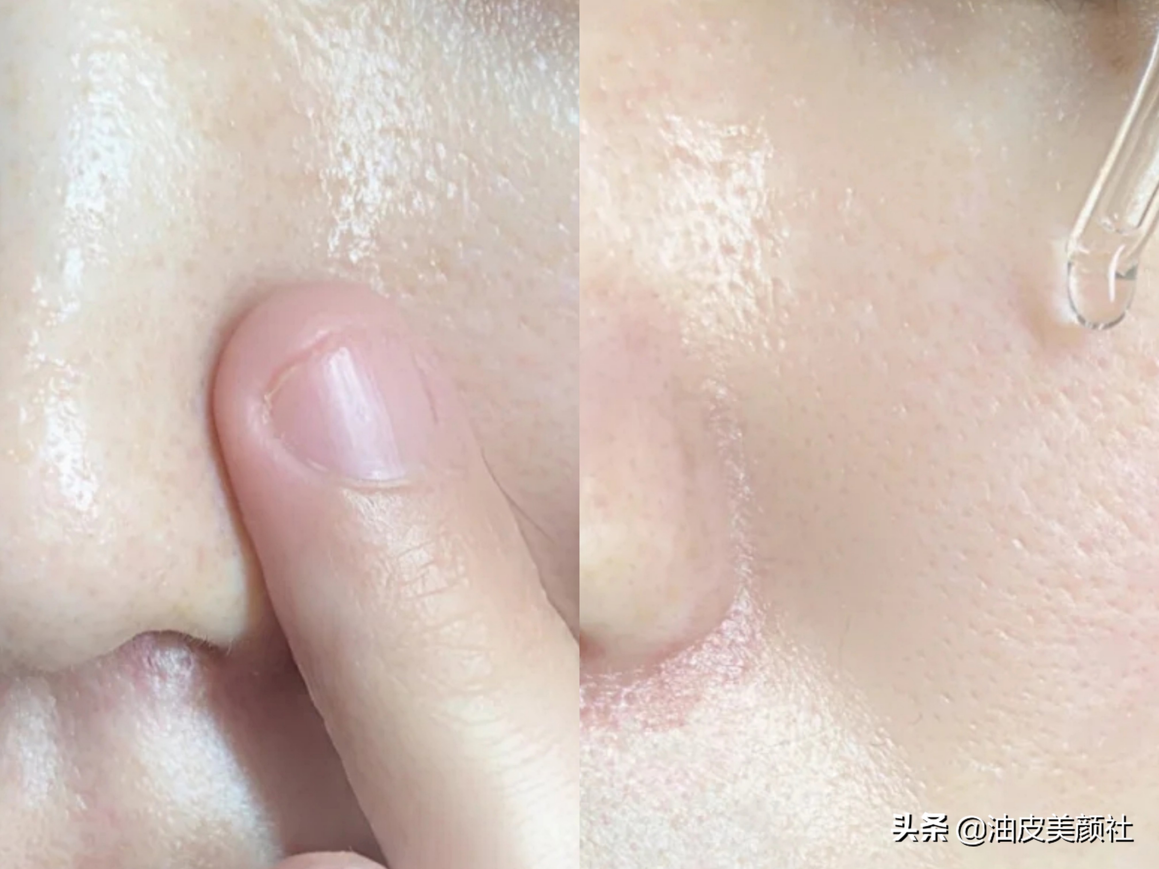 祛痘好物推荐一下,推荐十款实用的祛痘产品