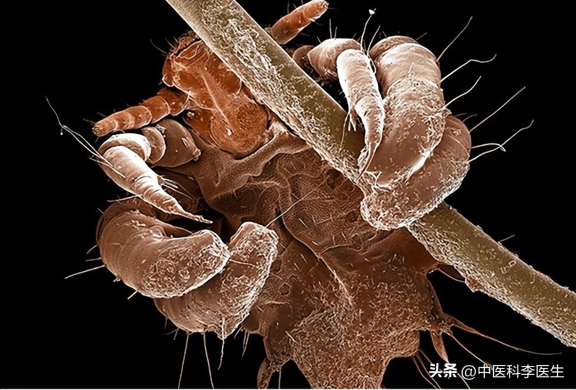 下体瘙痒发现两三只阴虱严重吗,阴部有几十只阴虱