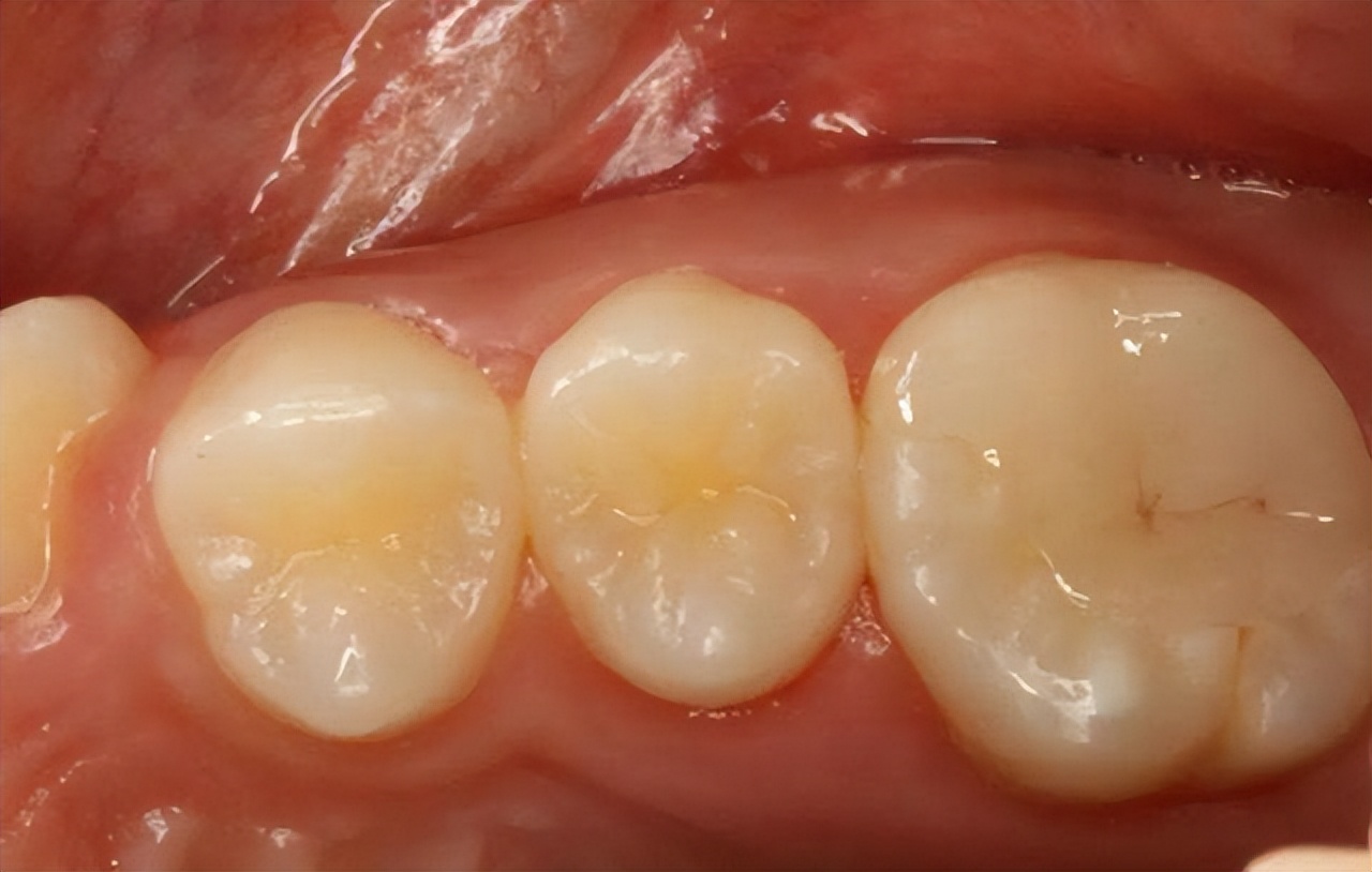 牙齿上抠下来的白色的东西臭臭的,从牙齿里抠出的臭臭的东西是什么