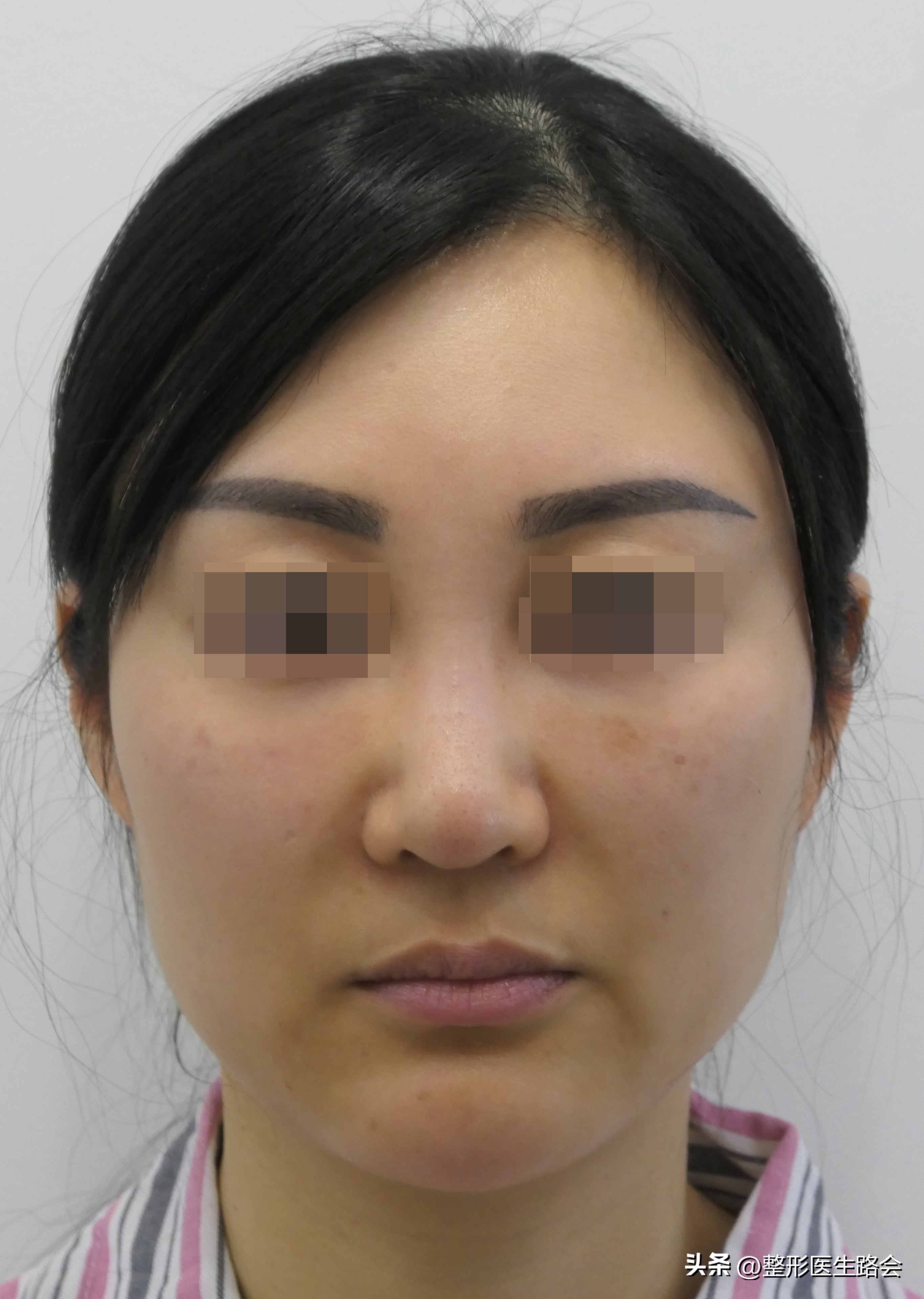 玻尿酸隆鼻立竿见影吗,玻尿酸隆鼻适合哪些鼻型