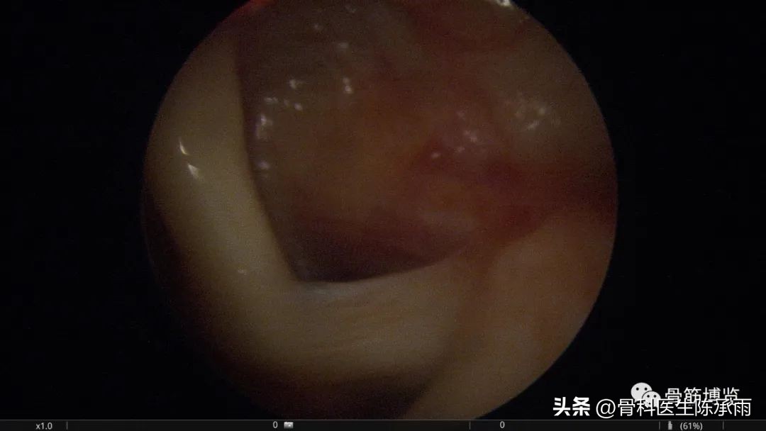 锁骨骨折保守治疗肩关节康复训练,肩锁骨远端骨折保守治疗要多久