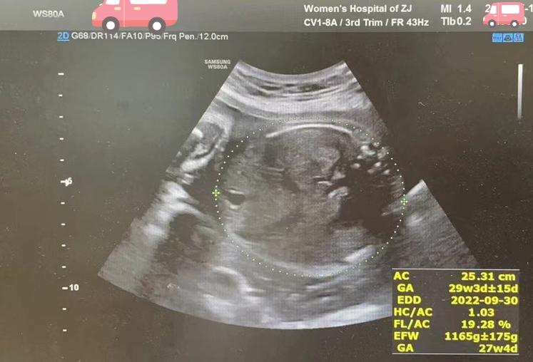 双胞胎娩出时间差,双胞胎生出来体重差多少正常