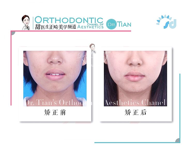 凸嘴下巴后缩拔牙改善有什么坏处,深覆合嘴凸下巴后缩矫正要拔牙吗