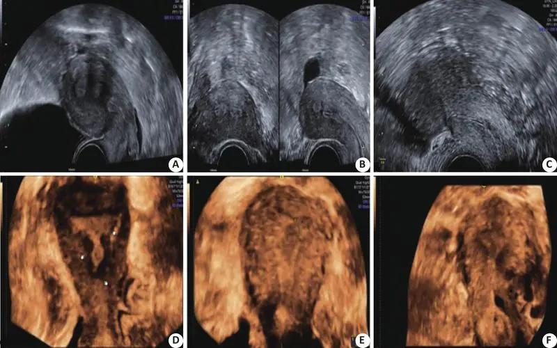 肾囊肿切除囊壁是大手术么,肾囊性占位一般是恶性的吗