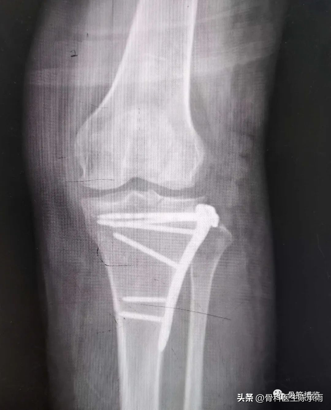 膝关节胫骨平台骨折,最近胫骨平台骨折视频