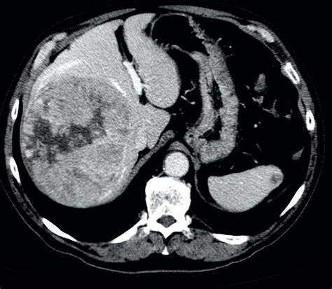 印度癌症和中国癌症谁多,近年中国和印度的癌症数据