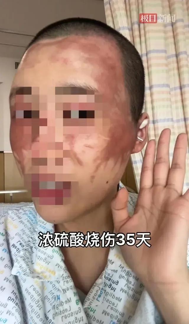 妙龄女子被泼硫酸的真正原因,25岁女子被泼硫酸