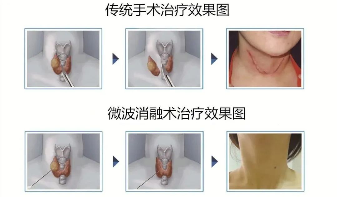 甲状腺结节恶性必须做碘131么,海盐含碘高吗甲状腺结节人能吃吗