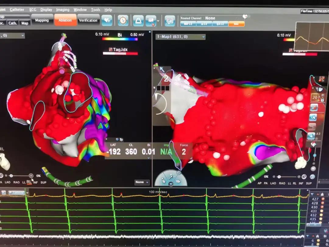 房颤怎么治疗讲座视频,房颤怎么治疗演示图